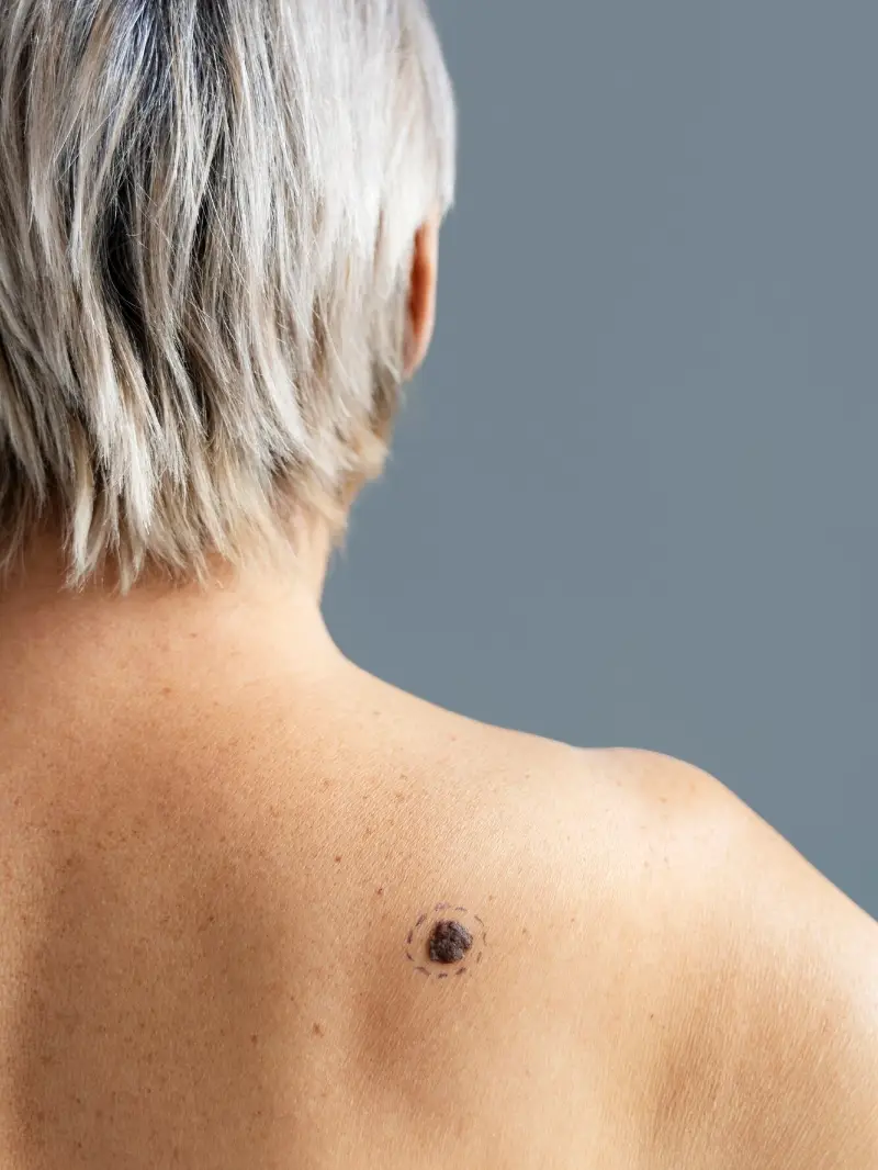 Back view woman with melanoma